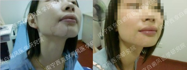 25岁女性面部白癜风治疗三个月