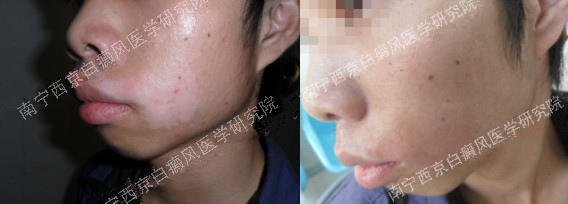 26岁男性脸部白癜风治疗二个月