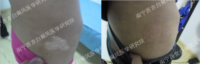 19岁女性腰部白癜风治疗二个月