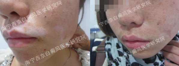 25岁女性嘴部白癜风治疗两月