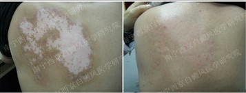 22岁男子背部白癜风治疗两个月