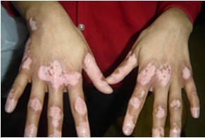 肢端型白癜风.jpg