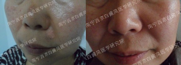 中年女性面部白癜风治疗两月
