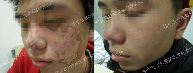 20岁大学生面部白癜风治疗四个月