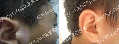 26岁男性面部白癜风治疗三月