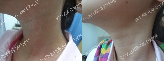 9岁女孩颈部白癜风治疗一月成功出院