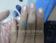 男性双手指末端及手背白斑成功康复案例