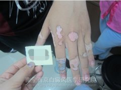 手指白斑成功康复案例(男,29岁)