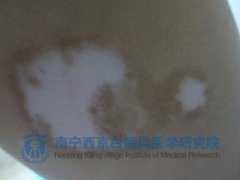 10岁学生上身白斑1年余康复出院