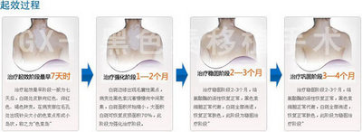 南宁白癜风治疗医院