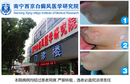 广西治疗白癜风医院