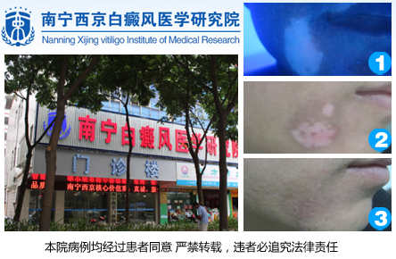 南宁哪家医院治疗白癜风.jpg