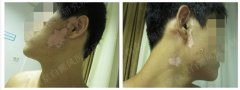 面部2年白斑成功门诊案例(男,28岁)