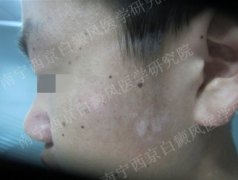 左面部白癜风4月余,最终成功康复