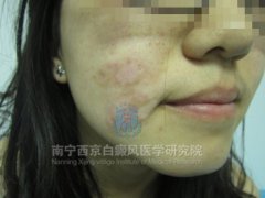 右面部白斑康复案例(24岁,女)