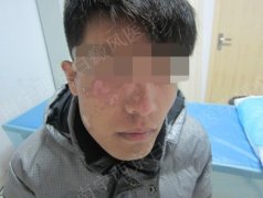 面部4年白斑成功门诊案例(男,32岁)