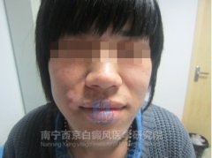 男性面部白癜风康复案例(28岁)