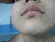 小女孩面部白斑治疗1月余康复出院