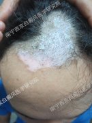 <b>19岁学生头部白癜风一年余,今在我院康复</b>