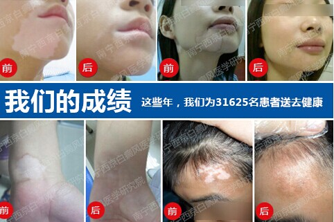 广西治疗白癜风医院.jpg