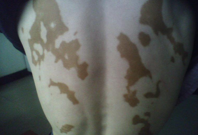 白癜风患者治疗需要注意哪些事情