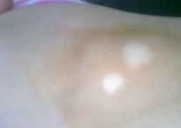 白癜风患者要怎样自我护理