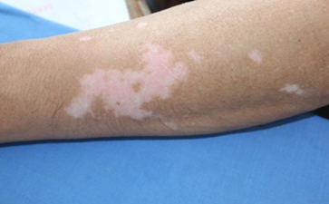 白癜风初期有什么危害