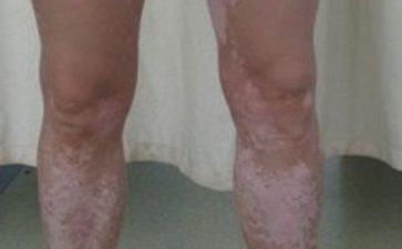 散发型白癜风的诱因是什么