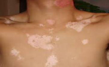 泛发型白癜风如何治疗