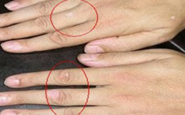 节段型白癜风有什么样的症状