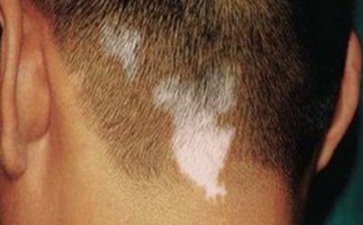 ÍêÈ«ÐͰ×ñ°·çµÄ±íÏÖÖ¢×´ÊÇʲô