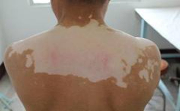 白癜风扩散过快该如何预防