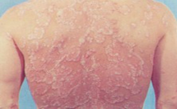 白癜风的护理要点都有哪些