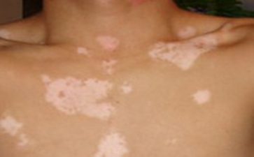 局限型白癜风该怎么护理