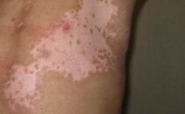 肢端型白癜风的危害都有哪些