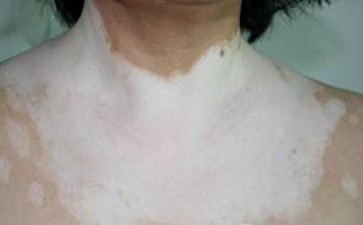 白癜风不治的话会怎么样