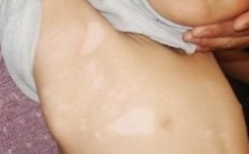 浅谈白癜风的危害