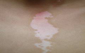 白癜风对患者心理影响有哪些因素