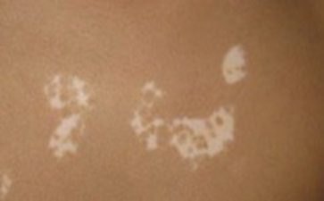 白癜风的预防方法究竟有哪些