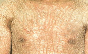 白癜风患者适合吃哪些食物