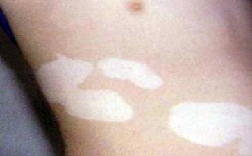 成年人怎么预防白癜风最好