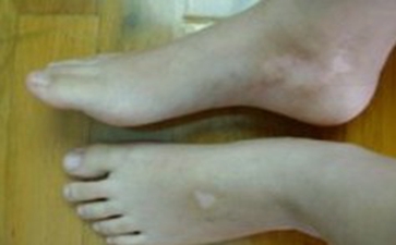 双脚白癜风病因有哪些