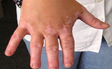 散发型白癜风诊断有哪些