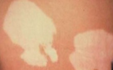 白癜风会影响生育吗