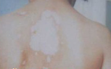 白癜风不可忽视的危害都有什么