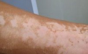 治疗白癜风的偏方哪些比较有效