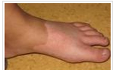 白癜风的诊断方法是什么