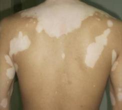 白癜风的护理怎么做,如何做好青少年白癜风护理