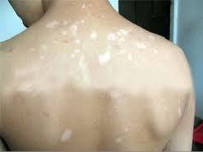 白癜风要如何治疗,中年男性白癜风该如何治疗