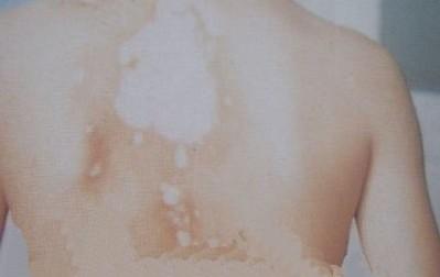 白殿疯患者应该吃什么,白癜风如何进行食疗好呢